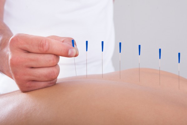 De ce este acupunctura atat de apreciata?